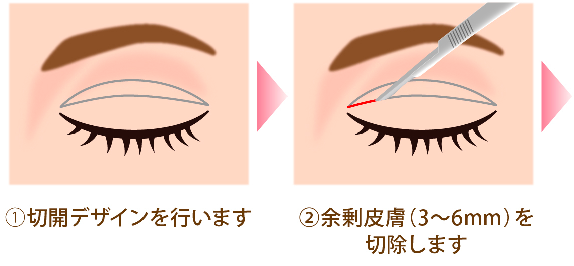 クイックベーシック法1点とめ