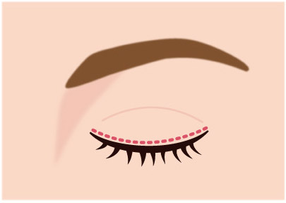 クイックベーシック法1点とめ