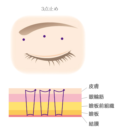 クイックベーシック法3点とめ