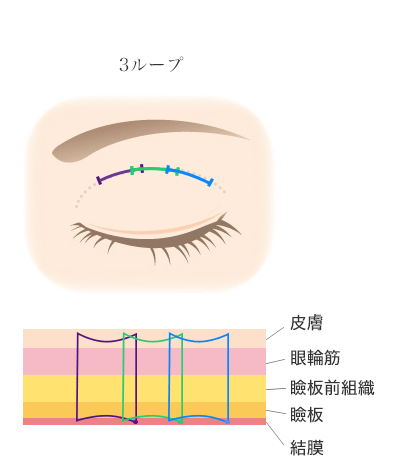 ルクスプレミアム法3ループ