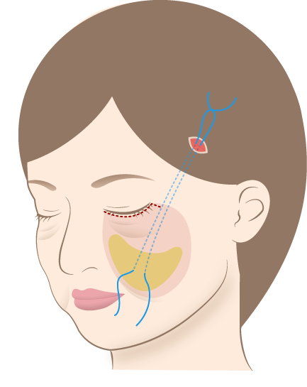 ミッドフェイスリフト1