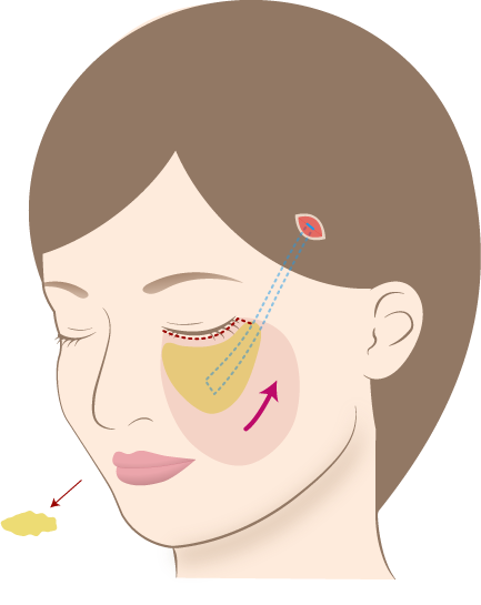 ミッドフェイスリフト2