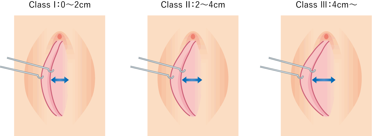 小陰唇肥大の重症度